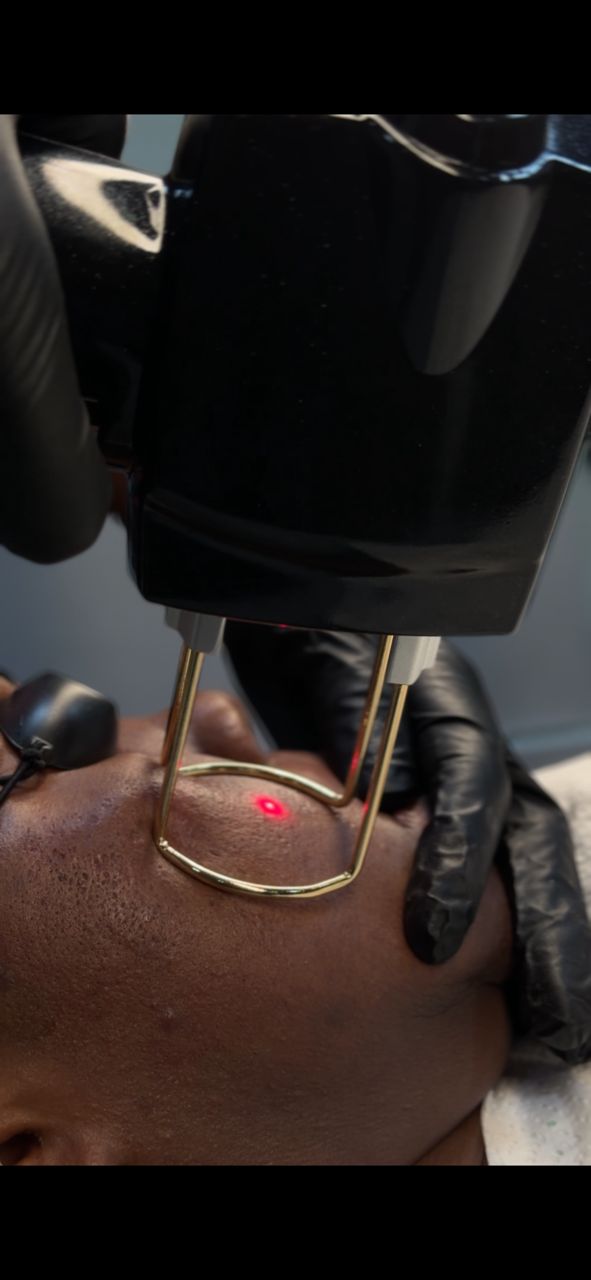 Carbon laser facial treatment in progress.