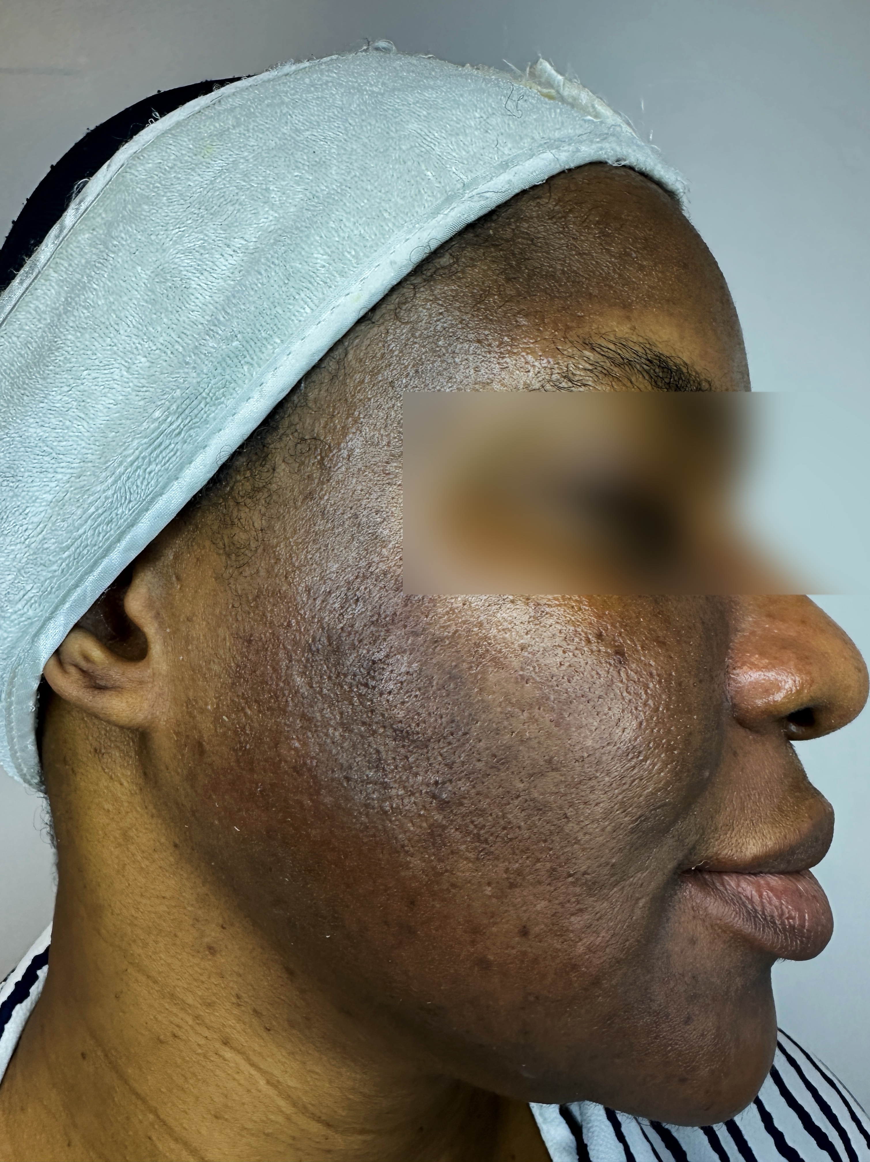 Client before treatment result story one at Hadi Spa.