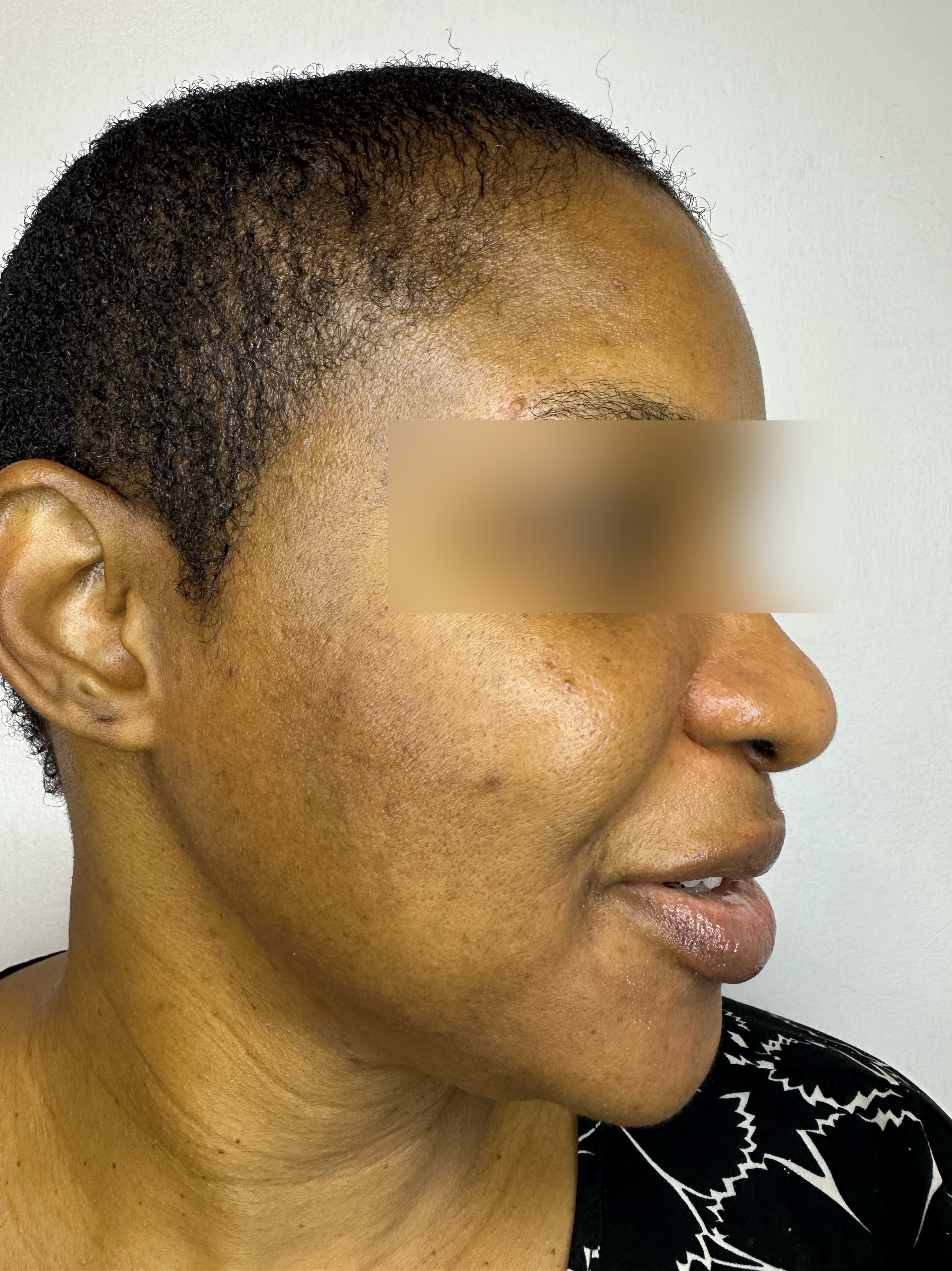 Client after treatment result story one at Hadi Spa.
