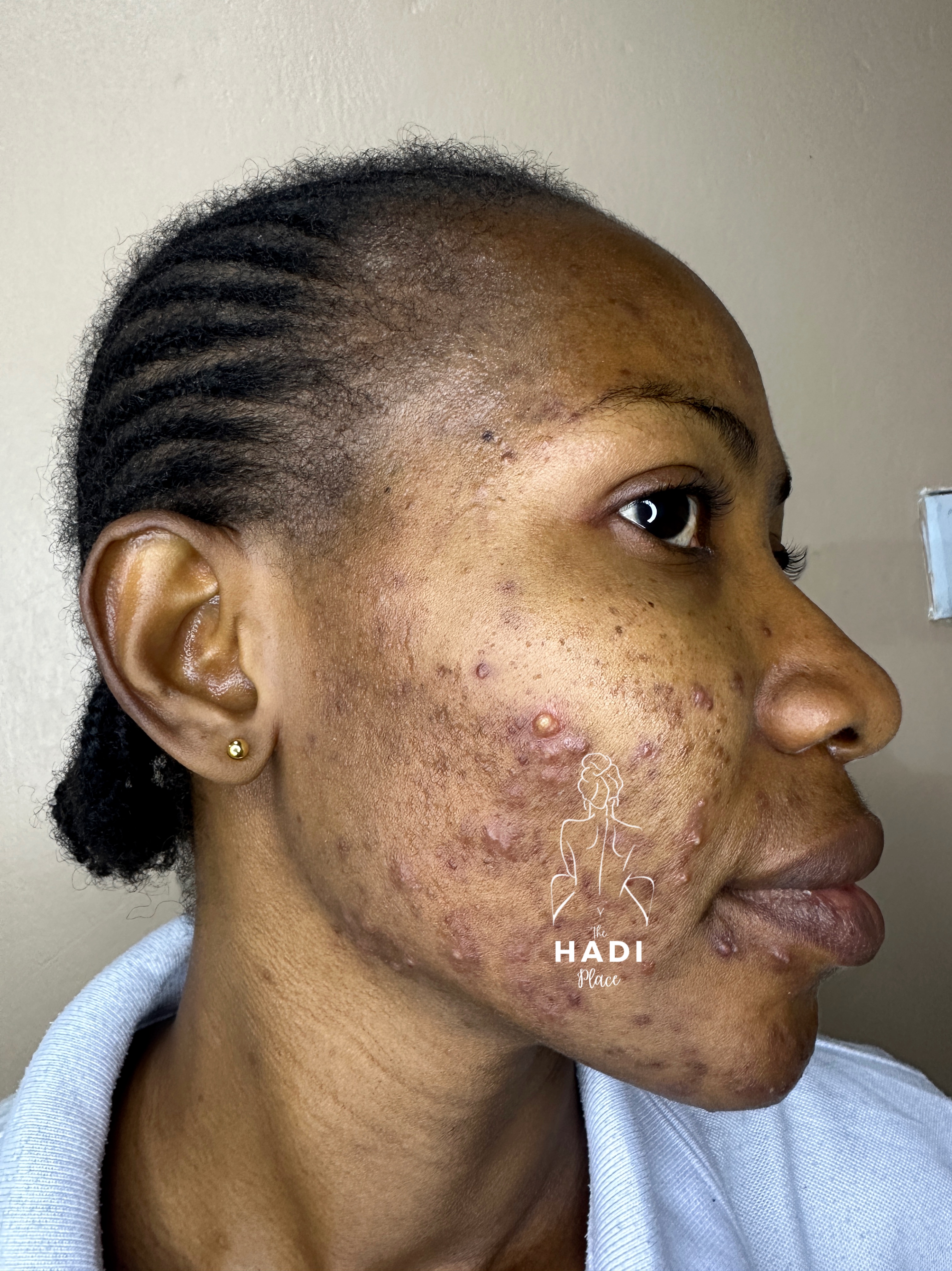 Client before treatment result story two at Hadi Spa.