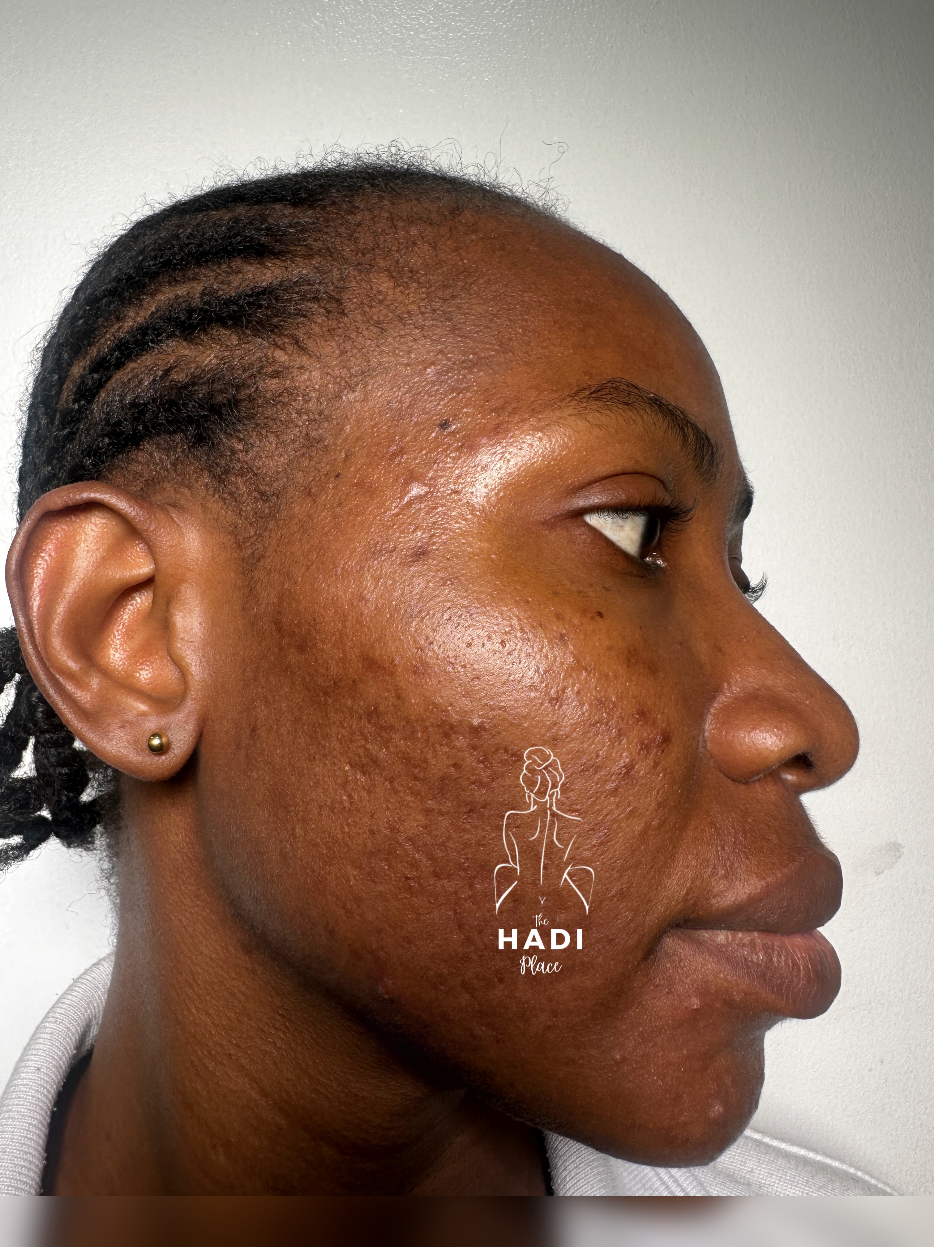 Client after treatment result story two at Hadi Spa.