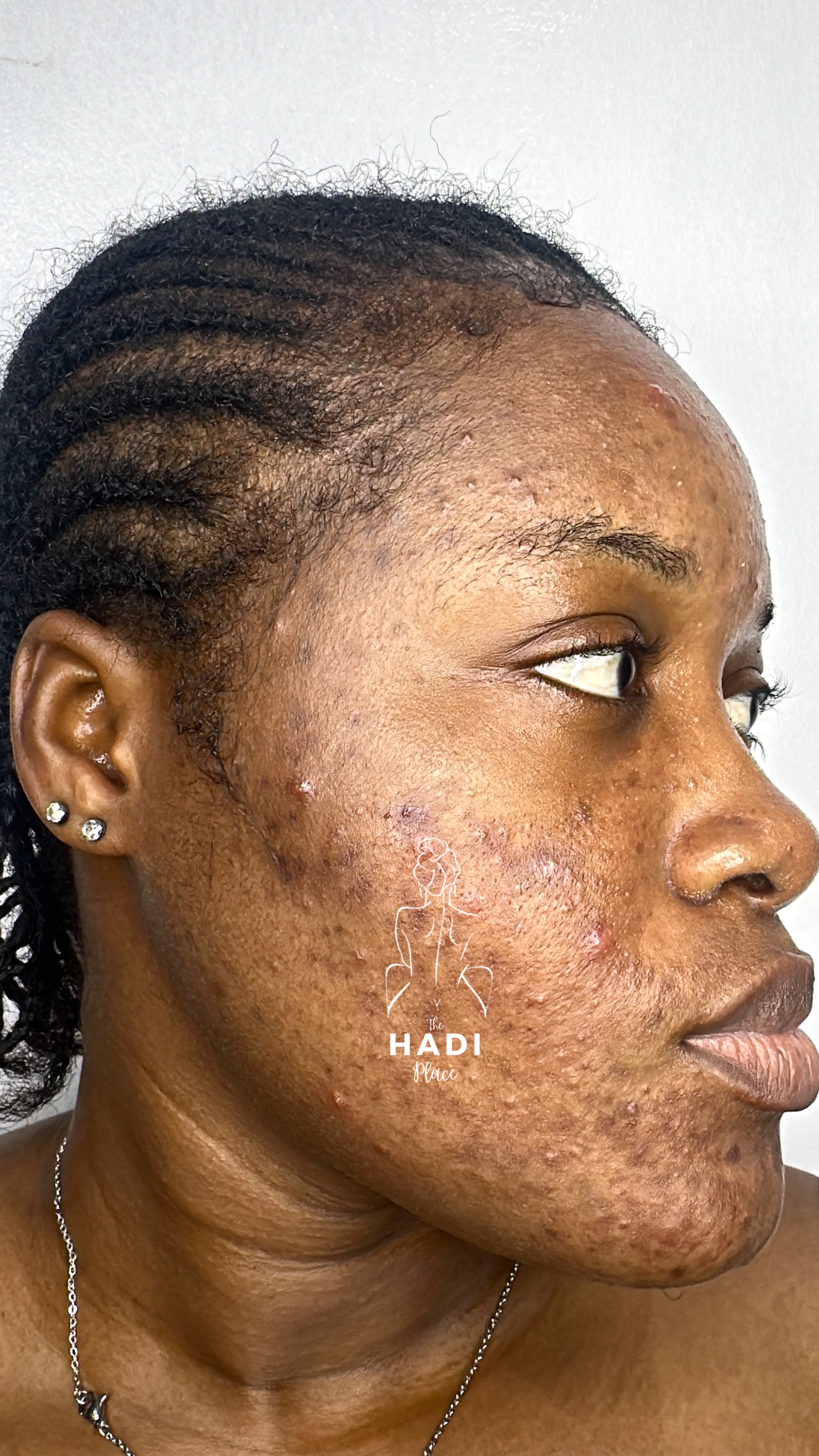 Client before treatment result story three at Hadi Spa.