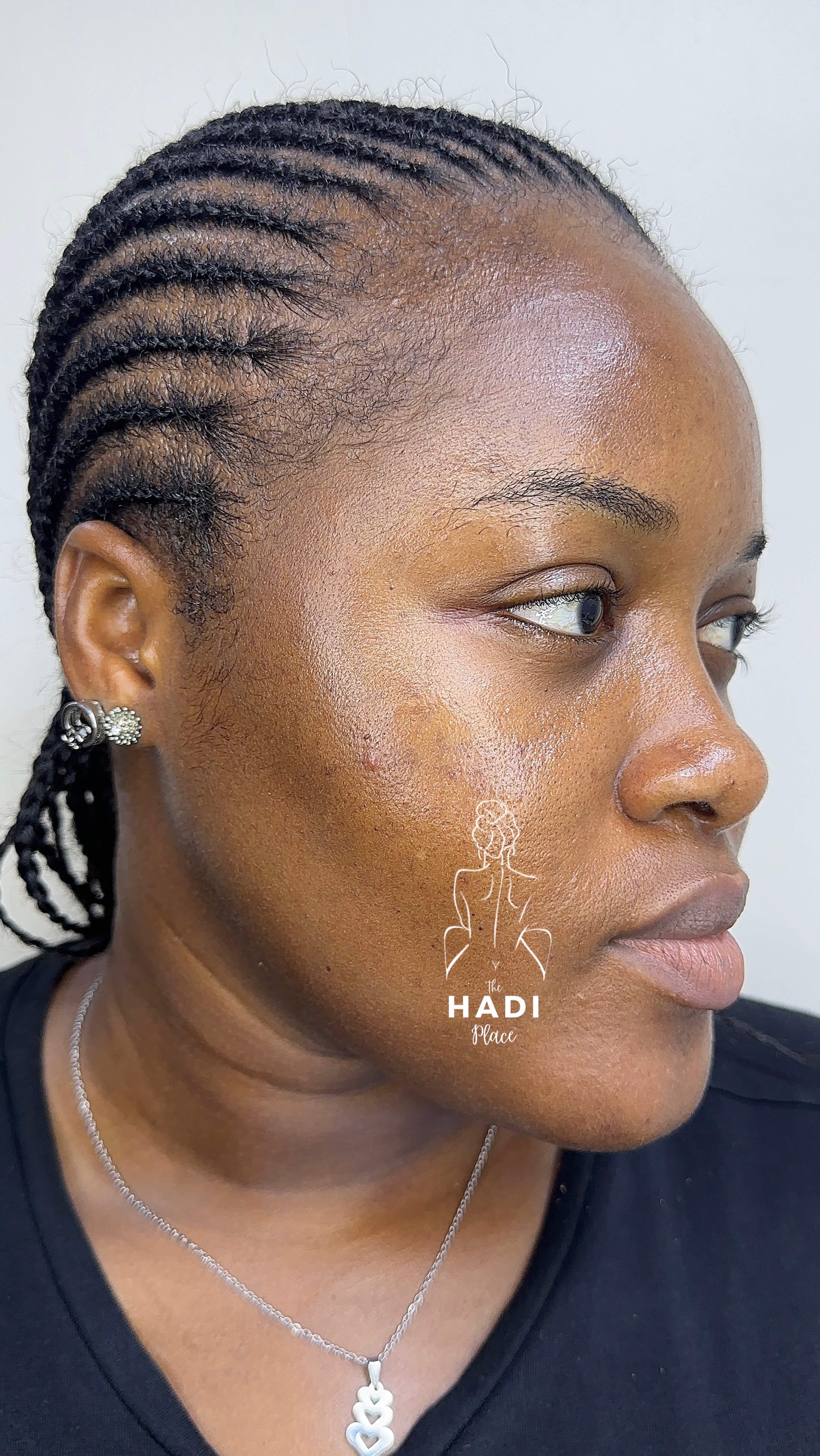 Client after treatment result story three at Hadi Spa.